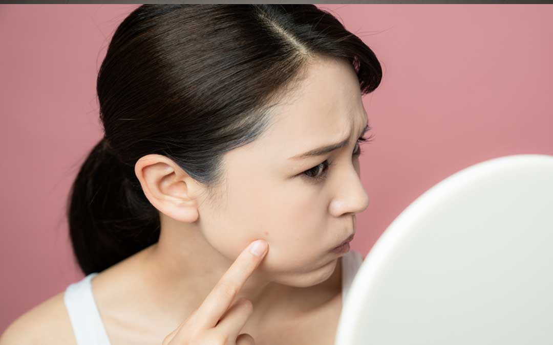 what Is Face Dysmorphia Acne